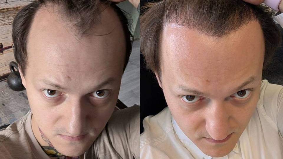 Операция по пересадке волос