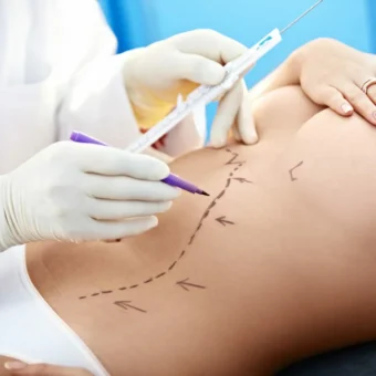 liposakciya liposakciya