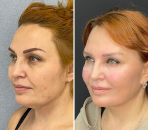 Лифтинг нижней трети лица и шеи (SMAS lifting), до и после