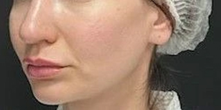 Уменьшение сосудистой сетки, выравнивание тона кожи. Создание четкого овала лица Уменьшение сосудистой сетки, выравнивание тона кожи. Создание четкого овала лица
