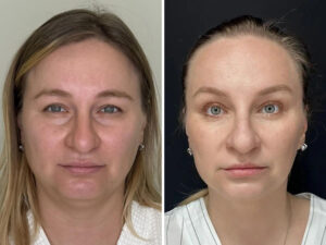 Фото до и после процедур для подтяжки лица после похудения. Клиника КЛАЗКО, Москва.